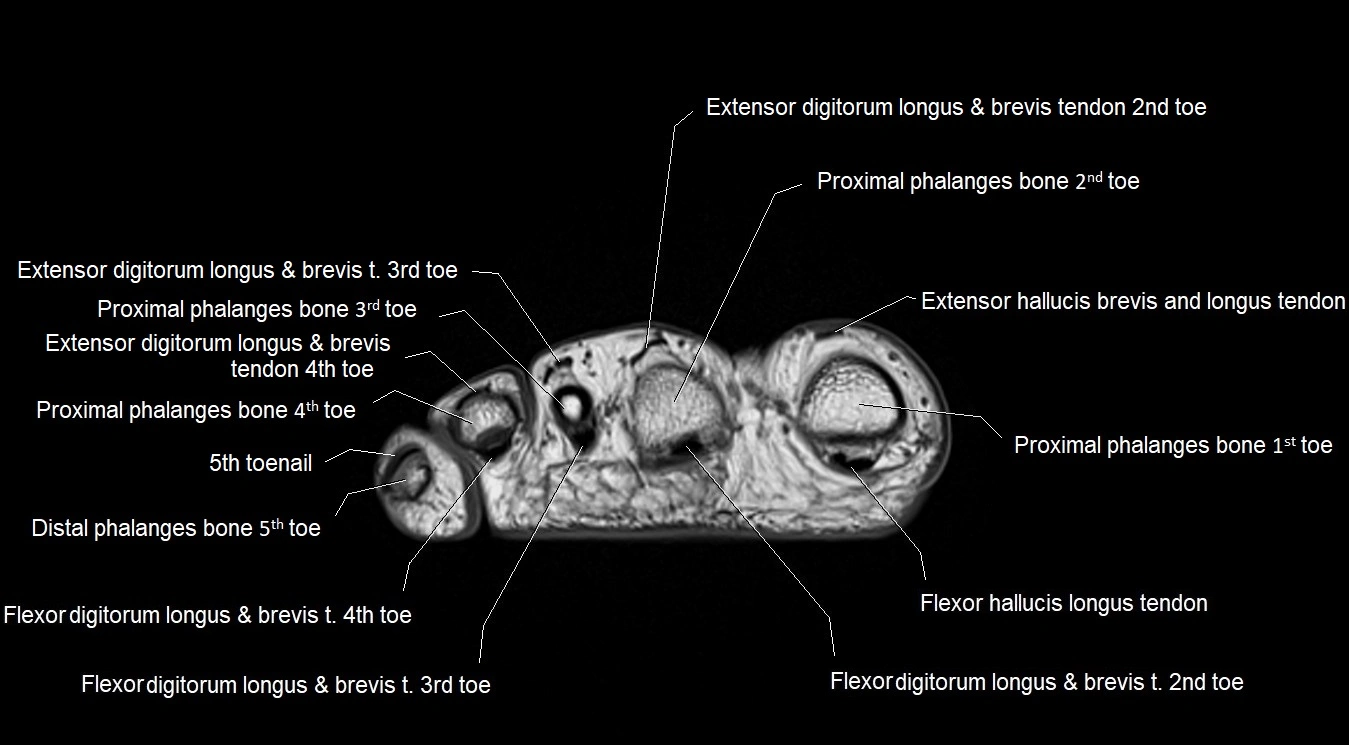 MRI 3T foot axial cross sectional anatomy image 32.webp